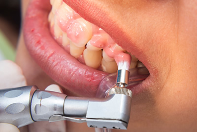 歯科プロフェッショナルケア