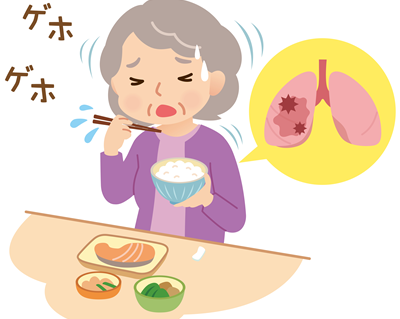 誤嚥性肺炎